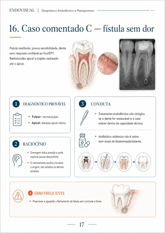 Ficha EndoVisual — Caso comentado: fístula sem dor